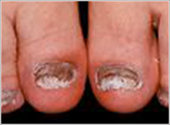 爪 白癬 菌 糖尿病は爪白癬を引き起こす！最悪の場合、足が壊死します