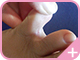 指の間の皮めくれ症状の水虫1
