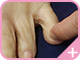 指の間の皮めくれ症状の水虫2