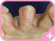 指の間の皮めくれ症状の水虫3