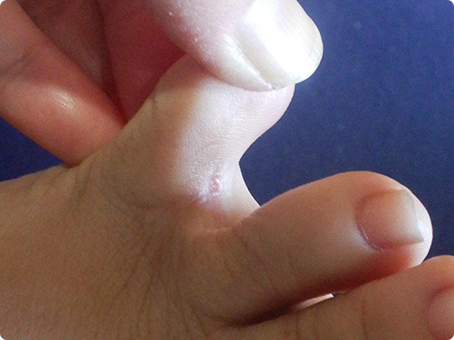 指の間の皮めくれ症状の水虫1