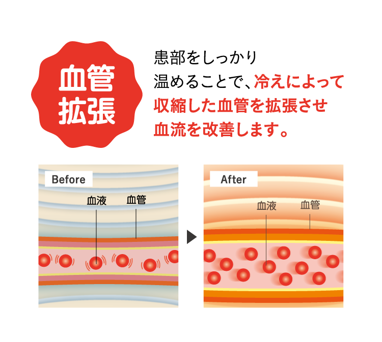 血管拡張