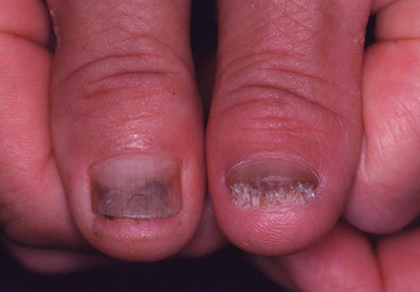 手・爪の症状例2